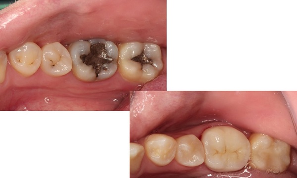 روش های درمان و رفع کرم خوردگی و پوسیدگی دندان ها در خانه