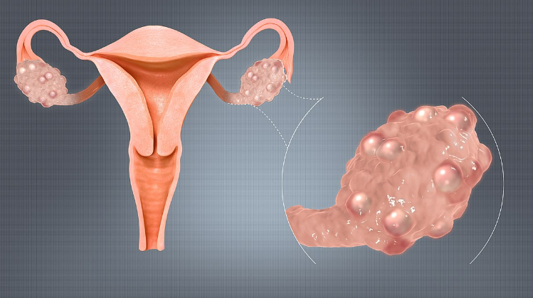 اطلاعات مهم درباره سندرم تخمدان پلی کیستیک/ علائم+ تشخیص+ درمان