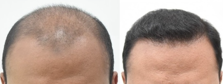 درمان سریع ریزش مو با چند روش ساده