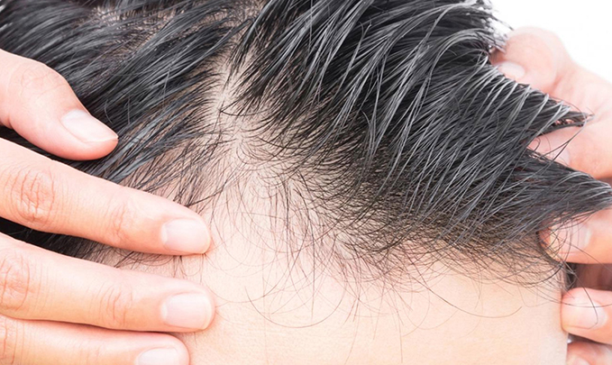 درمان سریع ریزش مو با چند روش ساده
